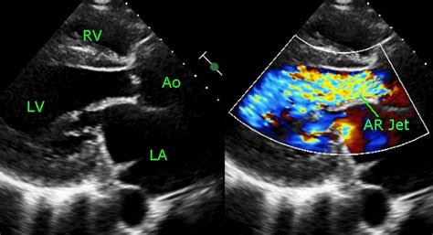 The value of echocardiography in aortic valve disease: an in 